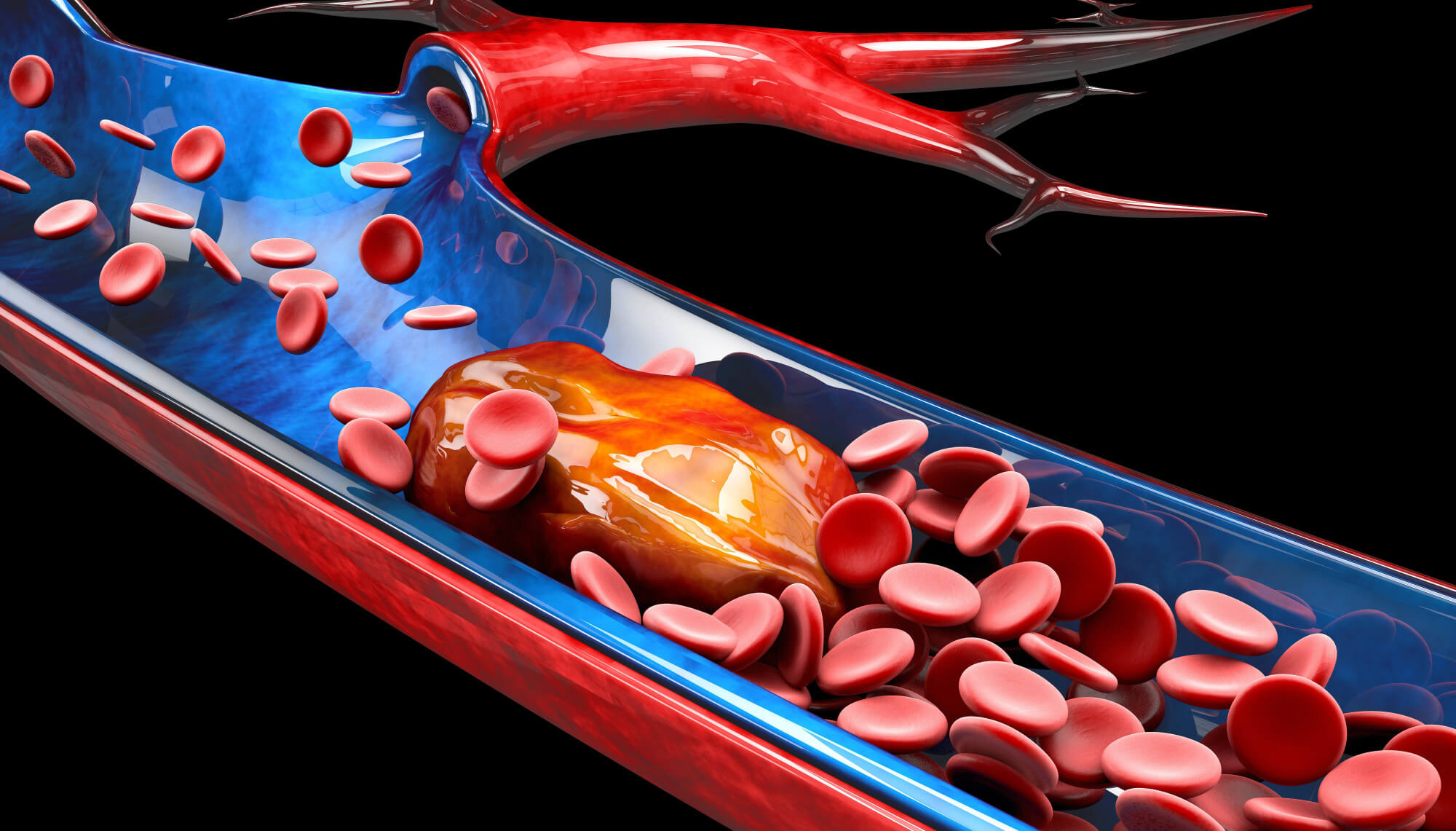 Keep it Flowing: The Top Must-Know Tips to Prevent Blood Clots