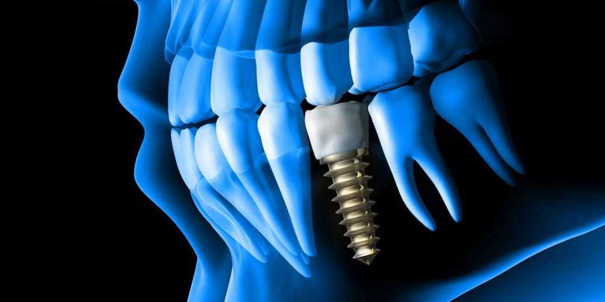 Pinnacle of Perfection: Best Dental Implants Treatment in Dubai